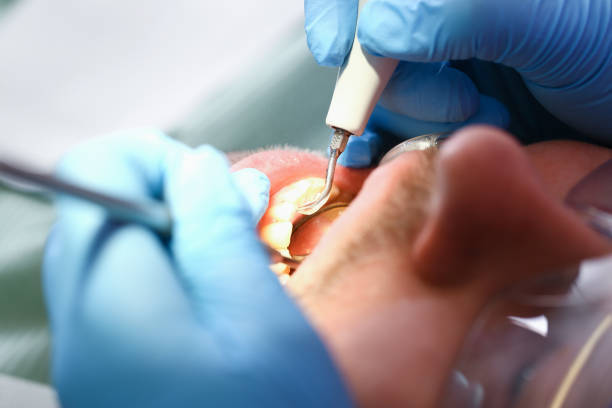 Best Broken or Chipped Tooth Repair in Bonnetsville, NC